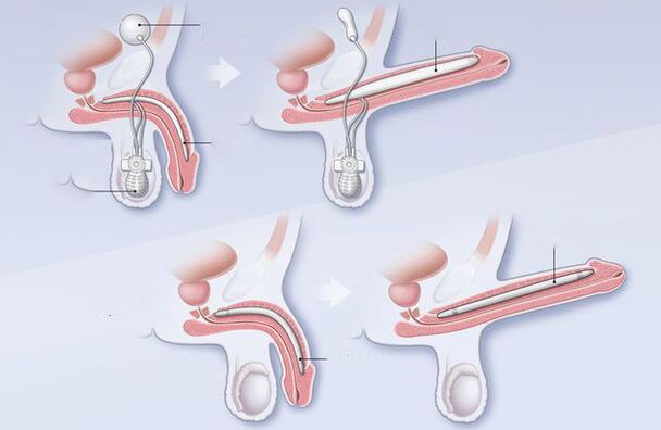 penis exam for impotence